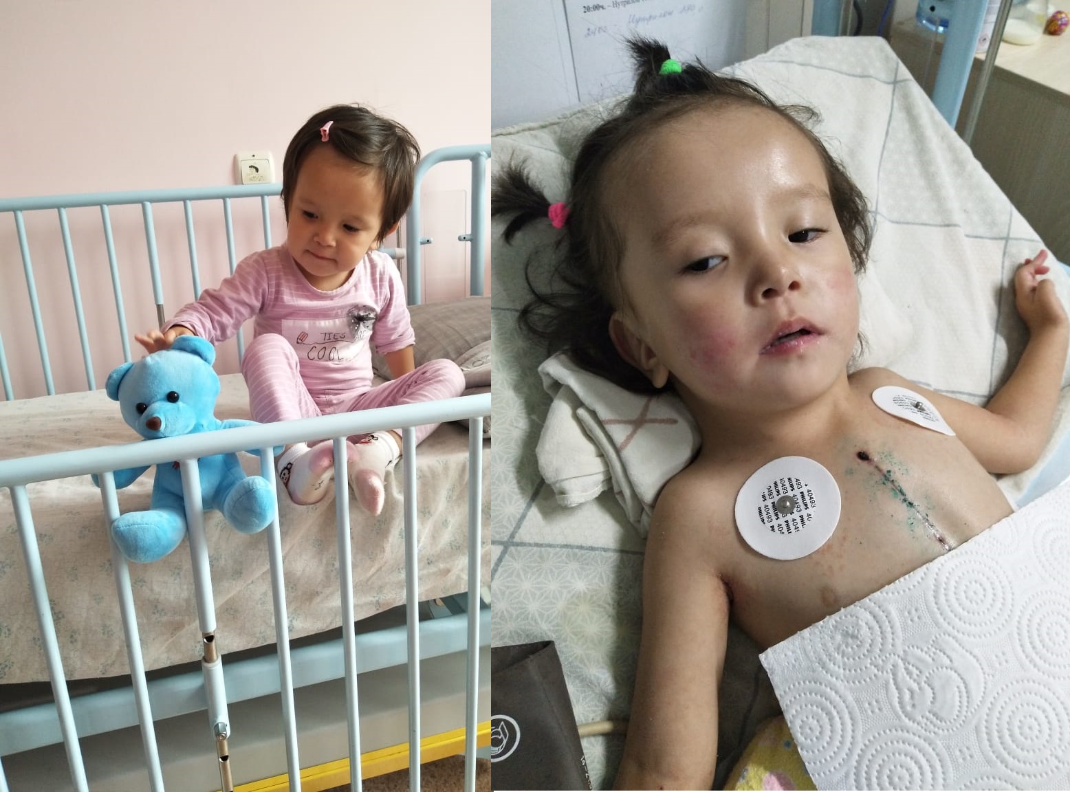 الماتىدا جۇرەگىنە وپەراتسيا جاساتقان بالانىڭ ءحالى اۋىر