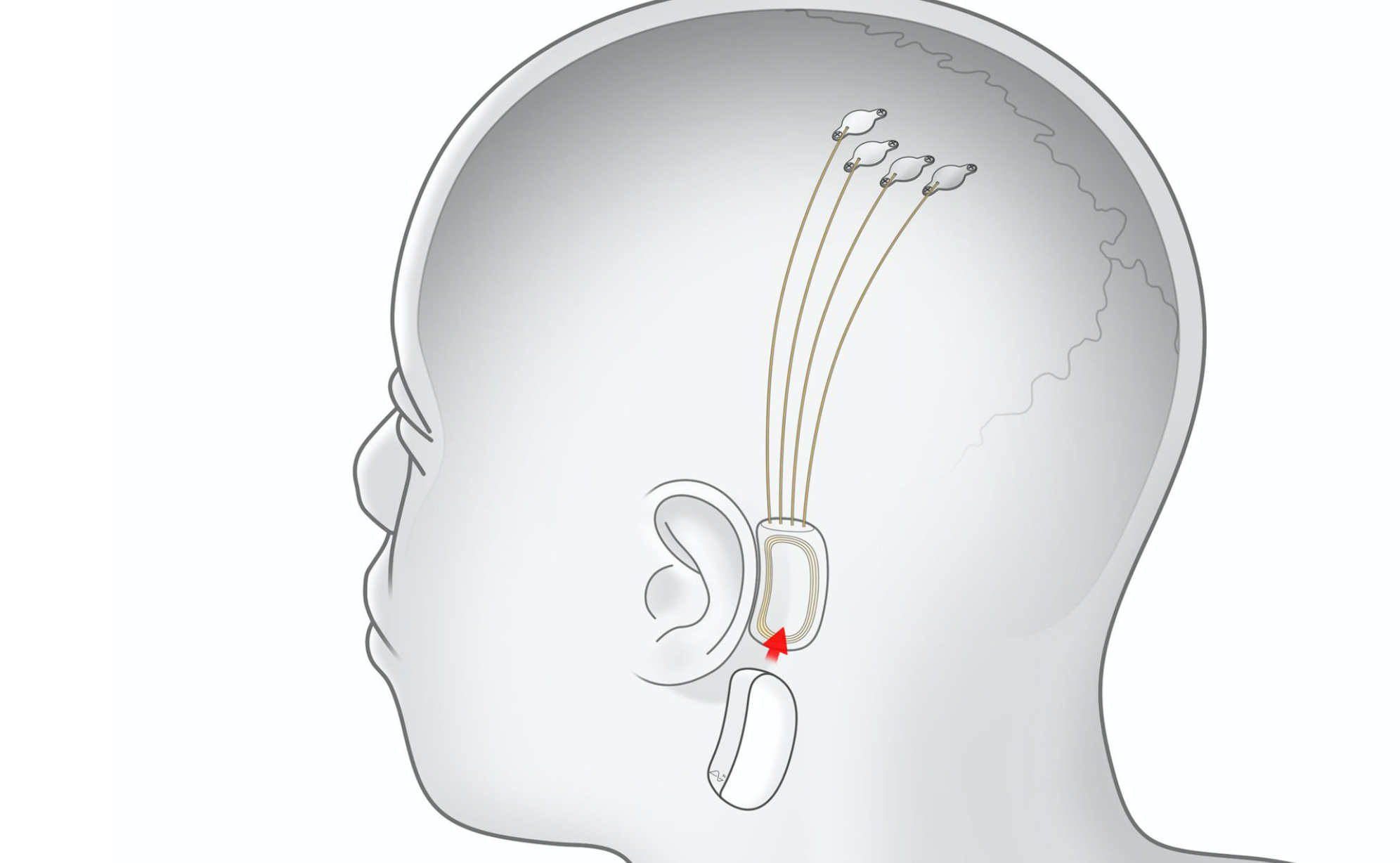 يلون ماسكتىڭ Neuralink جوباسى ءجىپ يمپلانتتارىن ۇسىندى