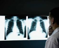 فليۋوروگرافيالىق تەكسەرۋدەن ءوتۋ ماڭىزدى