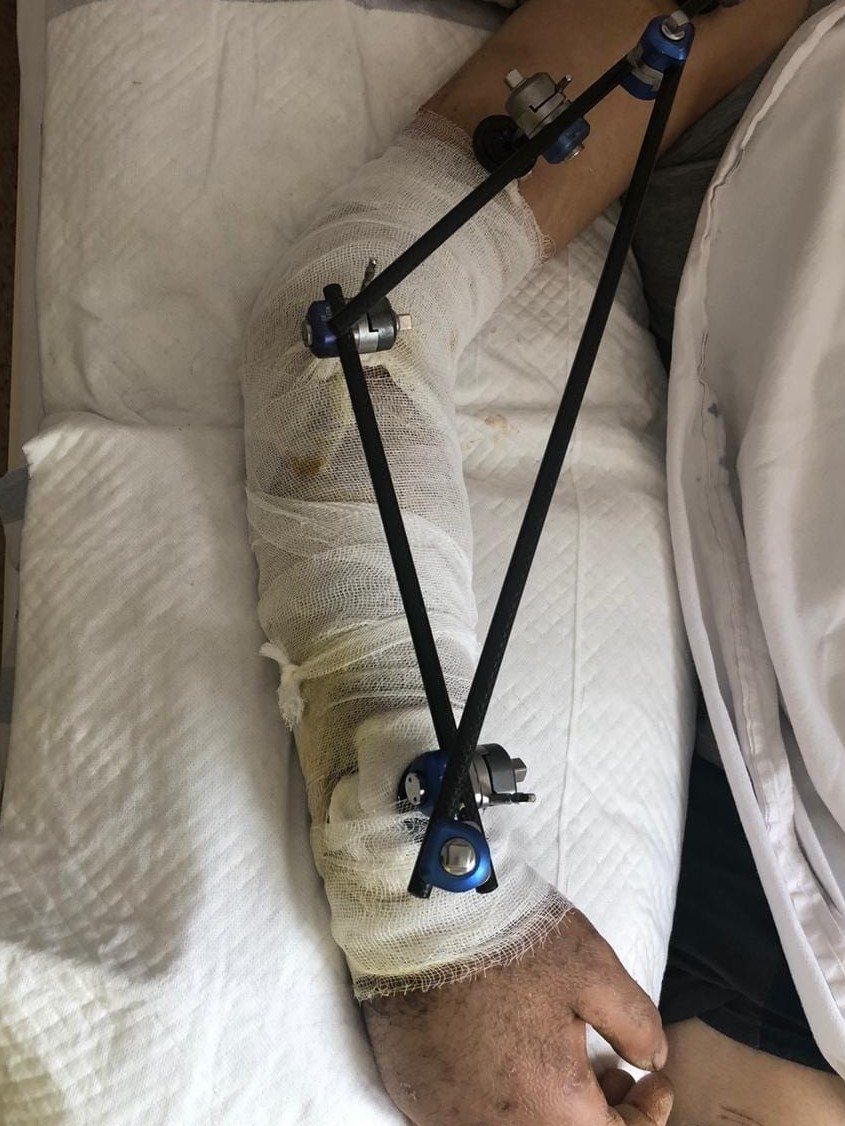 شىمكەنتتىك دارىگەرلەر قول سۇيەگى سىنعان جىگىتكە كۇردەلى وتا جاسادى