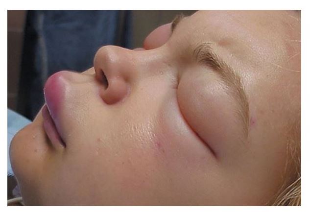 سيرەك كەسەلگە شالدىققان ناۋقاستاردىڭ دەرتى قالاي انىقتالادى؟