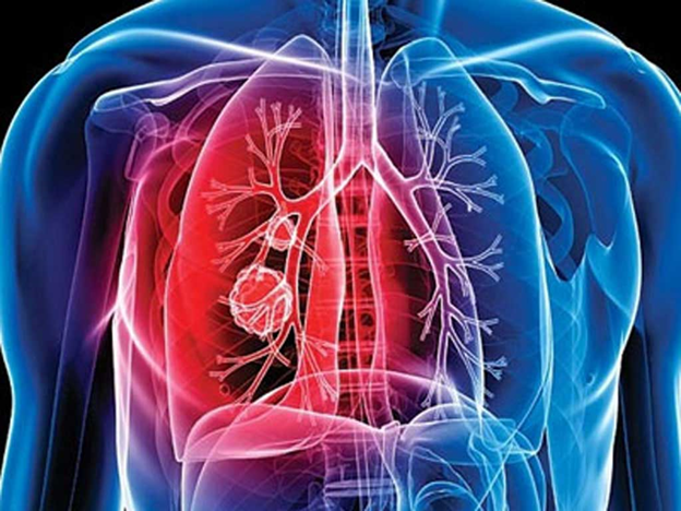 تۋبەركۋلەزگە شالدىققاندار 2,3 ەسەگە تومەندەگەن