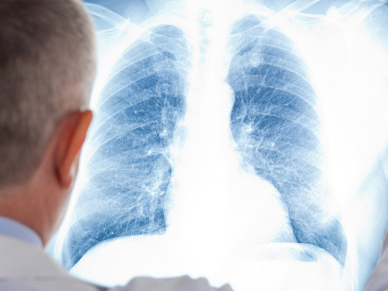 پنەۆمونيادان ەكى ازامات كوز جۇمدى