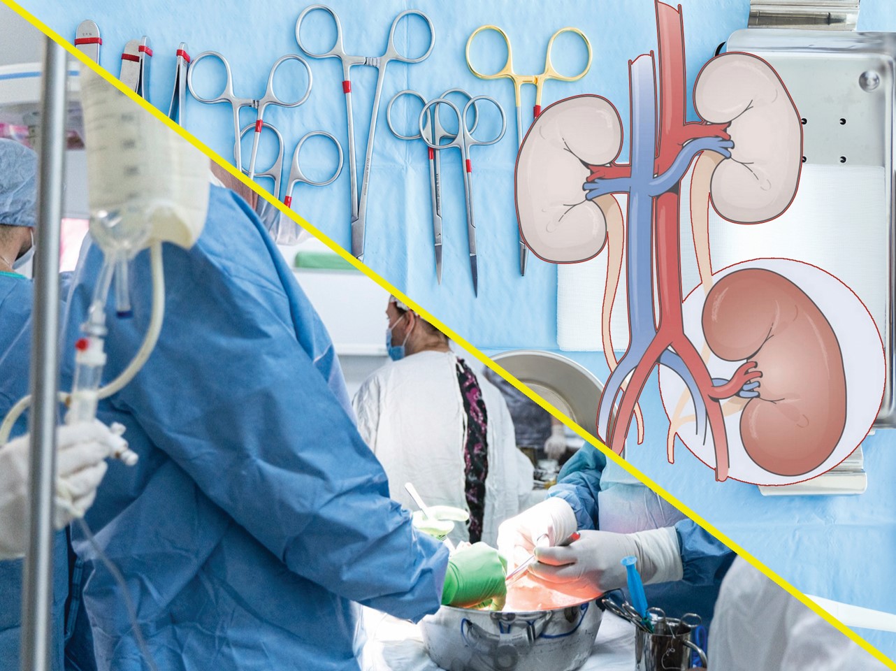 ترانسپلانتاتسيادا دونور تاپشى