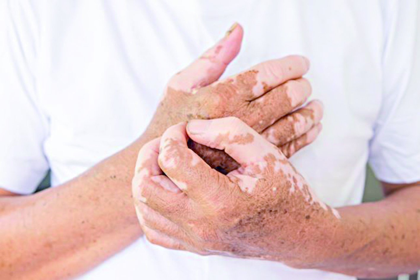 بەس جىلدا الاپەس اۋرۋى تىركەلگەن جوق