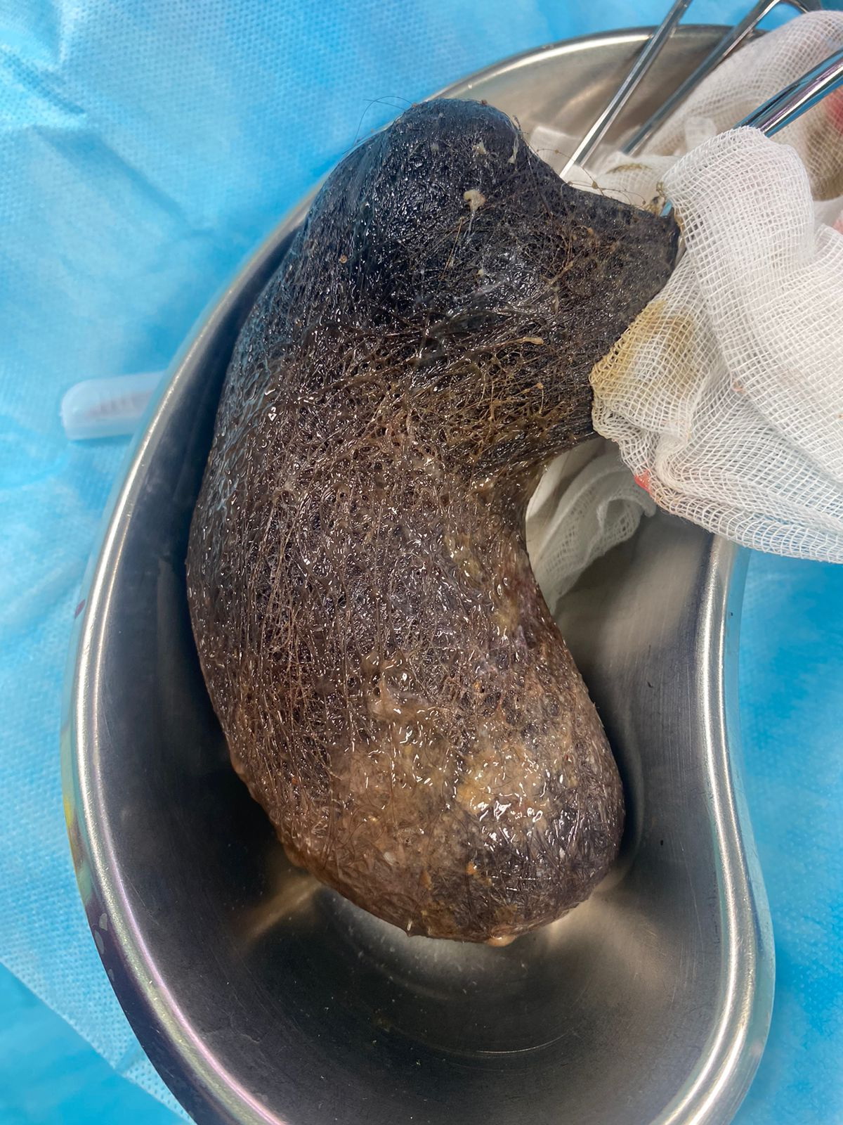 تريوتروتيللومانيا دەگەن قانداي كەسەل؟