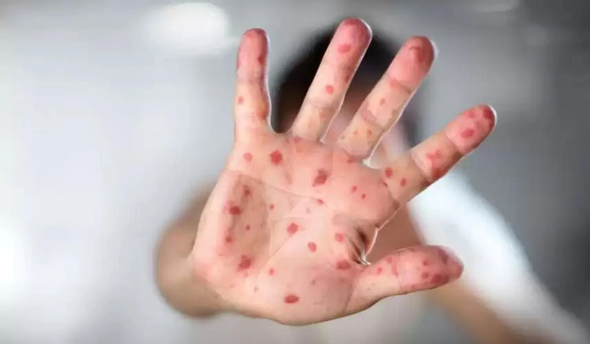 اباي وبلىسىنىڭ دارىگەرلەرى قىزىلشاعا قارسى ۆاكتسيا الۋعا شاقىردى