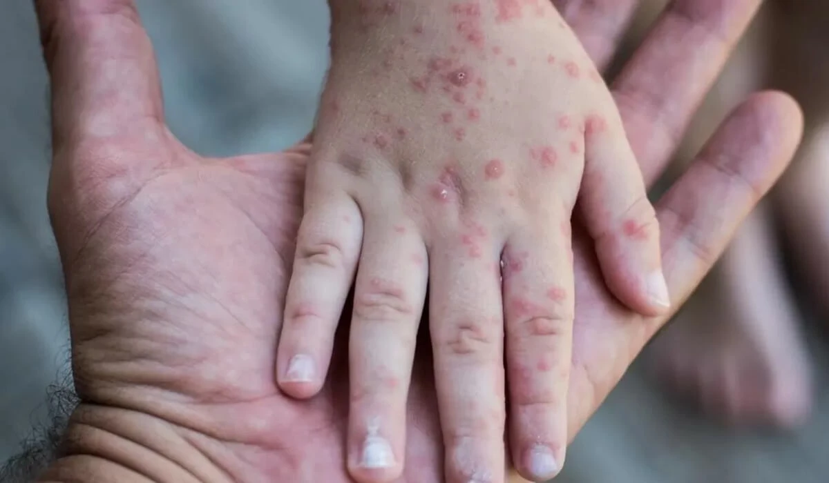 قىزىلشا جۇقتىرعان 4 بالا جانساقتاۋ بولىمىندە جاتىر