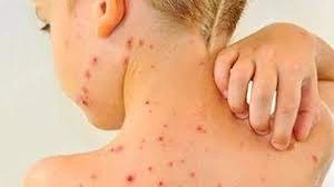 جۇقپالى دەرت كۇشەيىپ تۇر