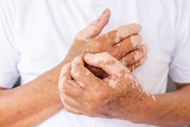 ەلىمىزدە سوڭعى جەتى جىلدا الاپەس اۋرۋى مۇلدە انىقتالماعان