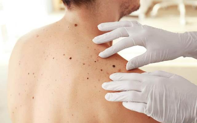 ادام پاپيللوما ۆيرۋسى قانداي اۋرۋ