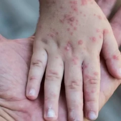 اتىراۋدا جۇزدەگەن ادامنىڭ قىزىلشا جۇقتىرعانى حابارلاندى