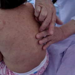 قىزىلشا جۇقتىرعان بالالار كوبەيگەن: دارىگەرلەر اتا-انالارعا ۇندەۋ جاسادى