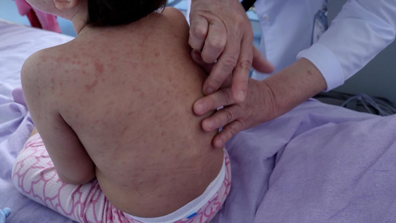 ەلىمىزدە قىزىلشا جۇقتىرۋ كورسەتكىشى 30%-عا تومەندەدى